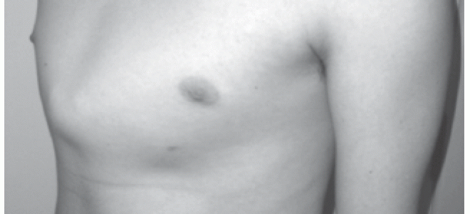 Что такое килевидная деформации грудной клетки