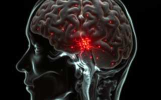 Опухоль глиального ряда: понятнее, чем кажется — как распознать, лечить и жить дальше