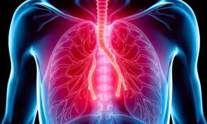 Как лечат пневмонию: понятная и практичная инструкция для пациентов и родственников