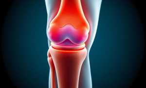 Артроскопия коленного сустава