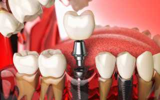 Имплантация зубов: восстановление улыбки и качества жизни