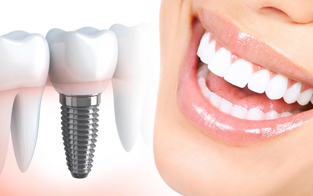 Имплантация зубов: восстановление улыбки и качества жизни
